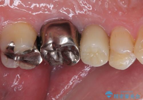 抜歯が必要な小臼歯　インプラントによる補綴治療の治療後
