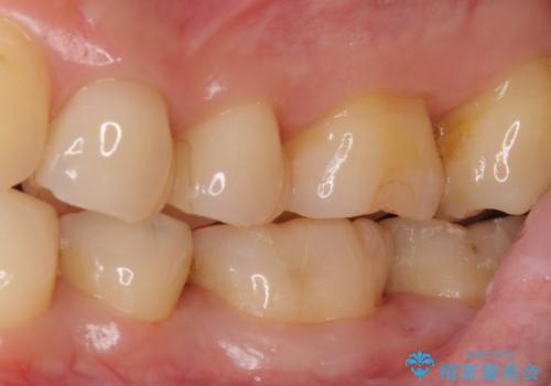 銀歯の横が虫歯、自費治療でやり直してセラミックにの治療後