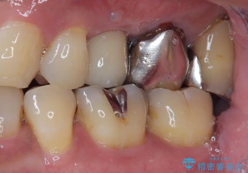 抜歯が必要な小臼歯　インプラントによる補綴治療の治療後