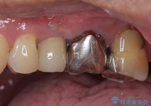 抜歯が必要な小臼歯　インプラントによる補綴治療