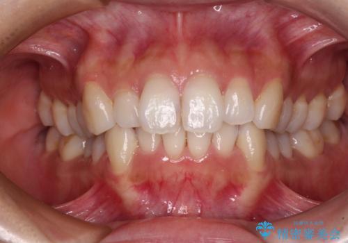 補助装置を用いて奥歯の咬み合わせを事前に改善　インビザラインによる矯正治療の症例 治療前