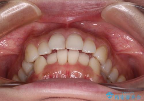 補助装置を用いて奥歯の咬み合わせを事前に改善　インビザラインによる矯正治療の治療前