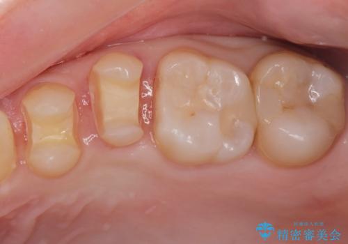 e-maxインレー治療の治療中