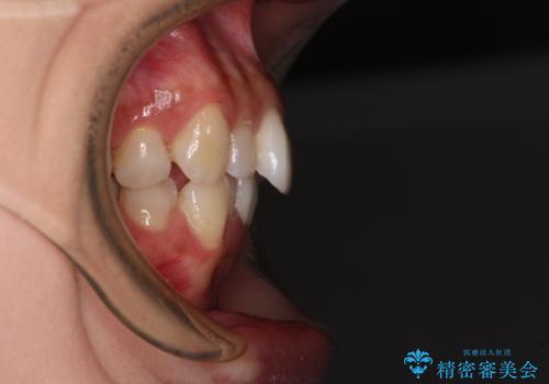 補助装置を用いて奥歯の咬み合わせを事前に改善 インビザラインによる矯正治療の治療前