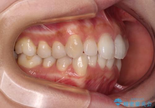 補助装置を用いて奥歯の咬み合わせを事前に改善 インビザラインによる矯正治療の治療前