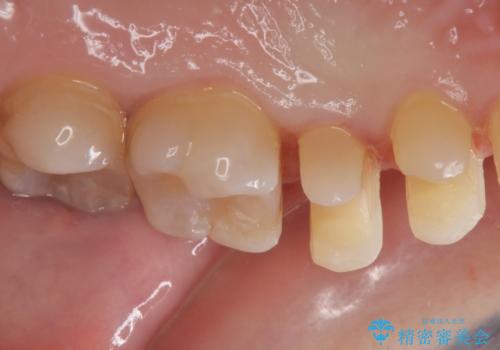 e-maxインレー治療の治療中