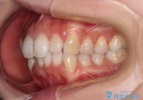 補助装置を用いて奥歯の咬み合わせを事前に改善　インビザラインによる矯正治療の治療前