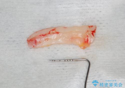 下がってきた歯茎を何とかしたい　歯肉移植による歯肉退縮の改善の治療中