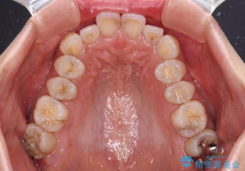 補助装置を用いて奥歯の咬み合わせを事前に改善 インビザラインによる矯正治療の治療前