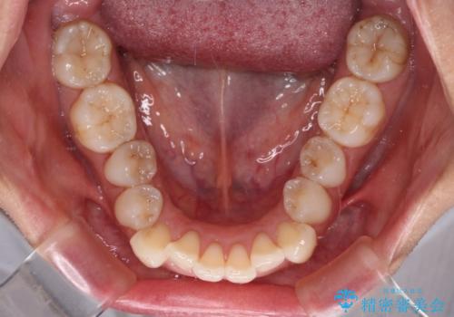 補助装置を用いて奥歯の咬み合わせを事前に改善 インビザラインによる矯正治療の治療前