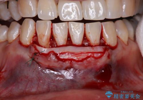 下がってきた歯茎を何とかしたい 歯肉移植による歯肉退縮の改善の治療中