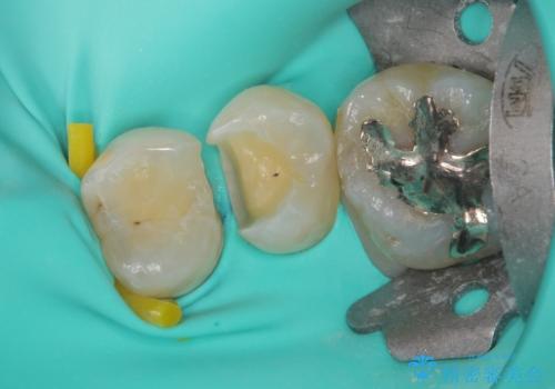 歯に穴があいてフロスが引っかかる　セラミックインレー修復の治療中