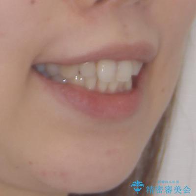 補助装置を用いて奥歯の咬み合わせを事前に改善 インビザラインによる矯正治療の治療前(顔貌)