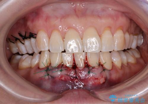 下がってきた歯茎を何とかしたい 歯肉移植による歯肉退縮の改善の治療中