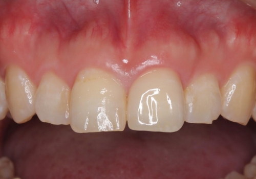 前歯が欠けた セラミッククラウンの症例 治療後
