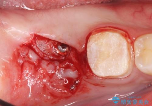 銀歯を白くしたい。(インプラント治療)の治療中