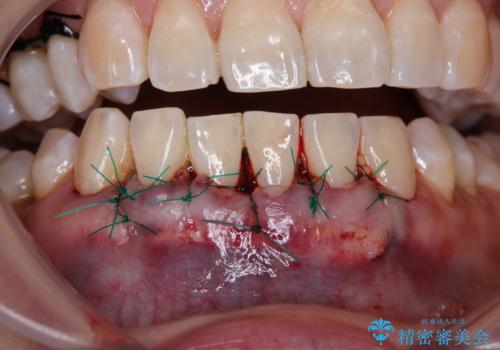 下がってきた歯茎を何とかしたい 歯肉移植による歯肉退縮の改善の治療中
