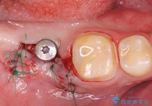 銀歯を白くしたい。(インプラント治療)の治療後