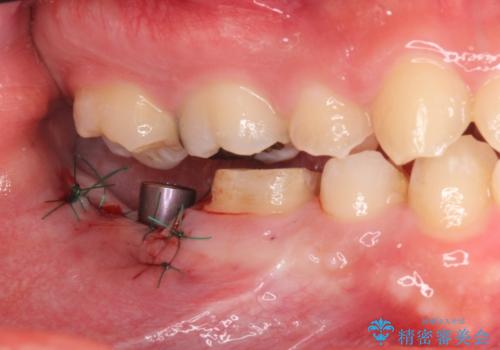 銀歯を白くしたい。(インプラント治療)の治療後