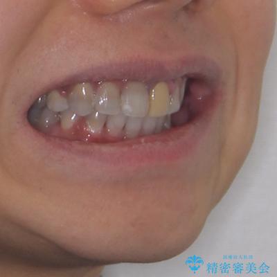 突出した前歯を引っ込める ワイヤー装置での抜歯矯正の治療後(顔貌)
