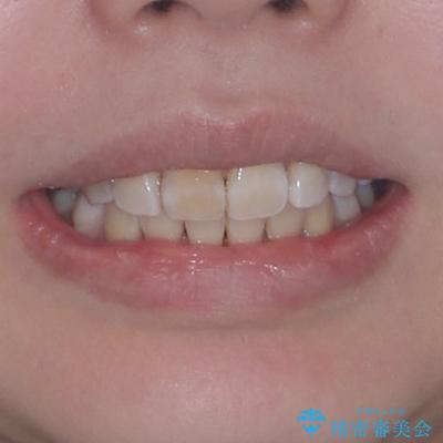 矯正の後戻りと奥歯の欠損 ワイヤー矯正とインプラント治療の治療後(顔貌)