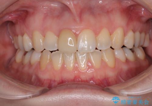 【モニター】後戻りでできた隙間 ワイヤー装置での再矯正の症例 治療後