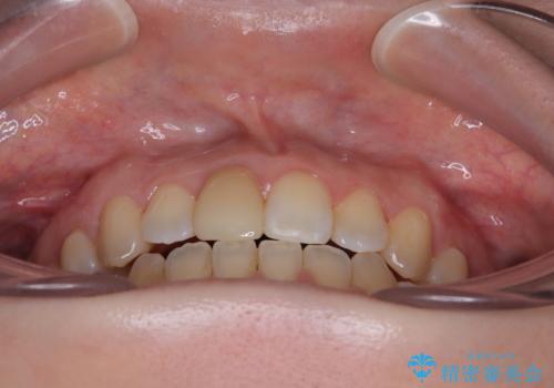 【モニター】後戻りでできた隙間 ワイヤー装置での再矯正の治療後