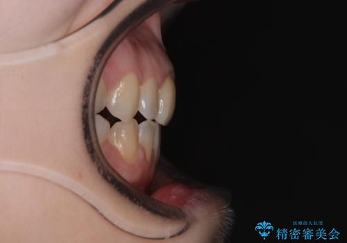 【モニター】後戻りでできた隙間 ワイヤー装置での再矯正の治療後