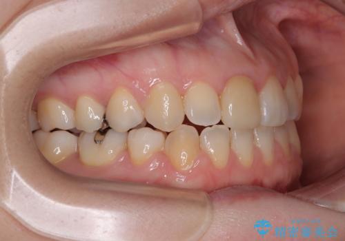 【モニター】後戻りでできた隙間 ワイヤー装置での再矯正の治療後