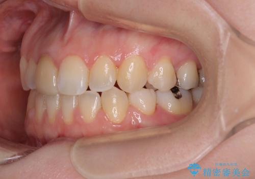 【モニター】後戻りでできた隙間 ワイヤー装置での再矯正の治療後