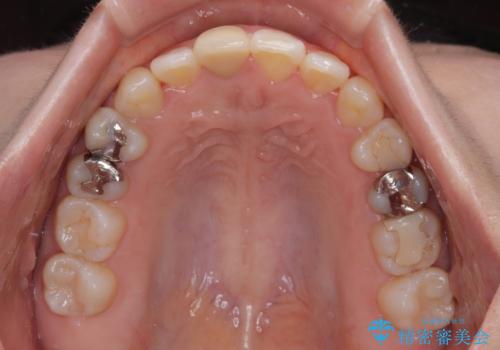 【モニター】後戻りでできた隙間 ワイヤー装置での再矯正の治療後