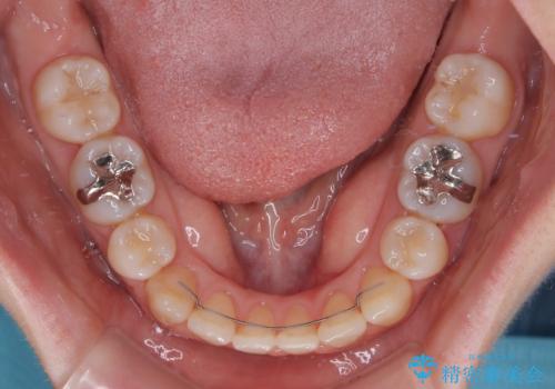【モニター】後戻りでできた隙間 ワイヤー装置での再矯正の治療後
