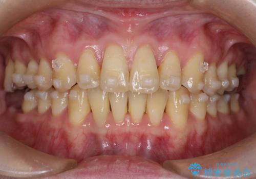 【インビザライン】前歯の捻れとオープンバイトの治療中
