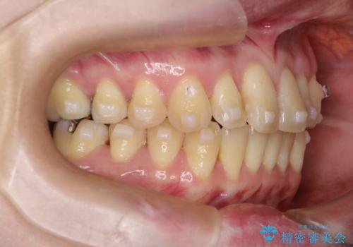 【インビザライン】前歯の捻れとオープンバイトの治療中