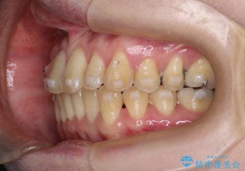 【インビザライン】前歯の捻れとオープンバイトの治療中
