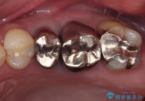 抜歯が必要な小臼歯　インプラントによる補綴治療の症例 治療前