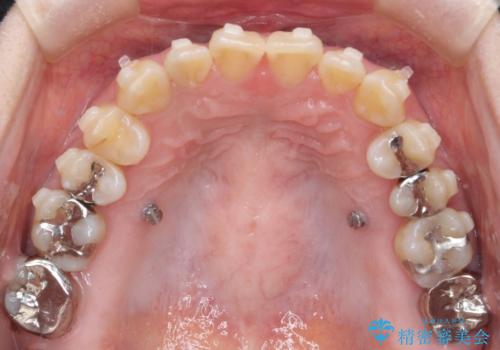 【インビザライン】前歯の捻れとオープンバイトの治療中