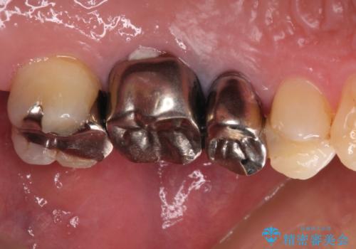 抜歯が必要な小臼歯 インプラントによる補綴治療の治療前