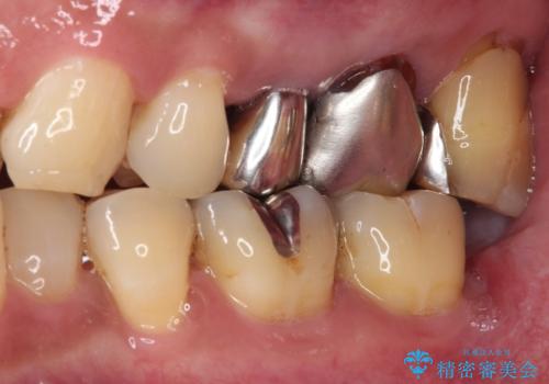 抜歯が必要な小臼歯 インプラントによる補綴治療の治療前