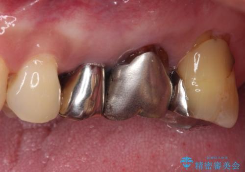 抜歯が必要な小臼歯　インプラントによる補綴治療の治療前