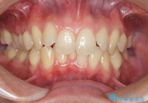 過蓋咬合・上顎前突・叢生を改善するマウスピース矯正の治療前