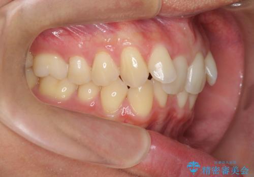 過蓋咬合・上顎前突・叢生を改善するマウスピース矯正の治療前