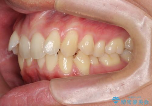 過蓋咬合・上顎前突・叢生を改善するマウスピース矯正の治療前