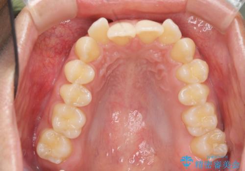 過蓋咬合・上顎前突・叢生を改善するマウスピース矯正の治療前