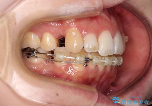 目立たない裏側装置でデコボコをきれいに解消の治療中