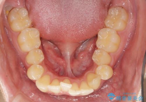 過蓋咬合・上顎前突・叢生を改善するマウスピース矯正の治療前