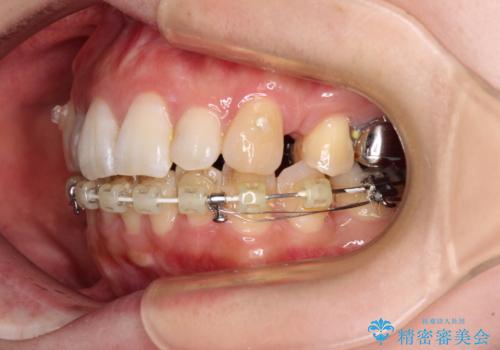 目立たない裏側装置でデコボコをきれいに解消の治療中