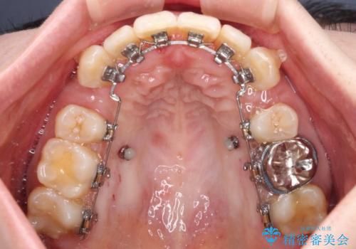 目立たない裏側装置でデコボコをきれいに解消の治療中