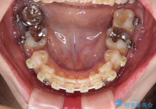 目立たない裏側装置でデコボコをきれいに解消の治療中