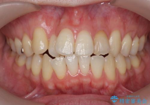 引っ込んだ前歯を並べたい　マウスピースと部分ワイヤーのコンビネーション矯正の症例 治療前